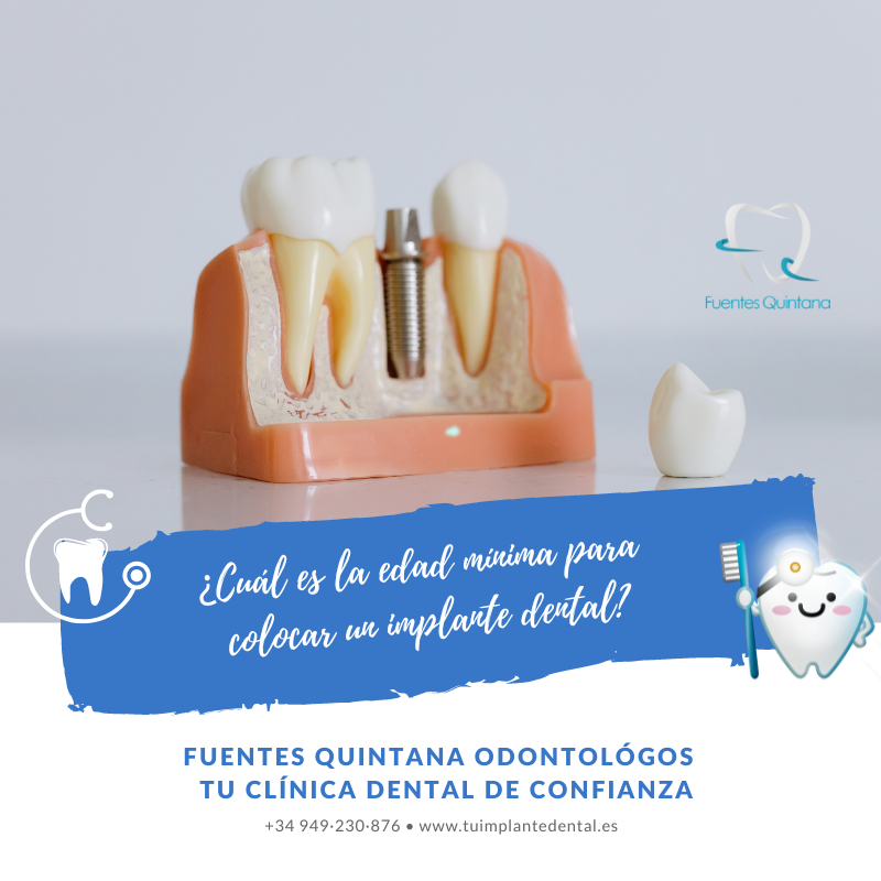 Cu L Es La Edad M Nima Para Un Implante Dental