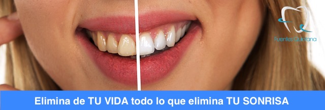 "Alimentos y bebidas que manchan los dientes FuentesQuintana odontologos Guadalajara"