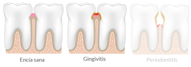 ¿Qué es la gingivitis?