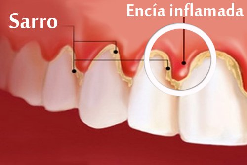 "¿qué es la Gingivitis?"