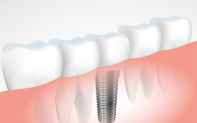 ¿ Cuánto dura un implante dental ?