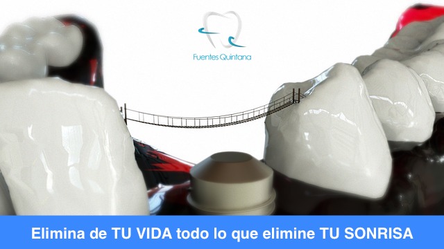 "qué es el implante dental Fuentes Quintana Odontólogos Guadalajara"