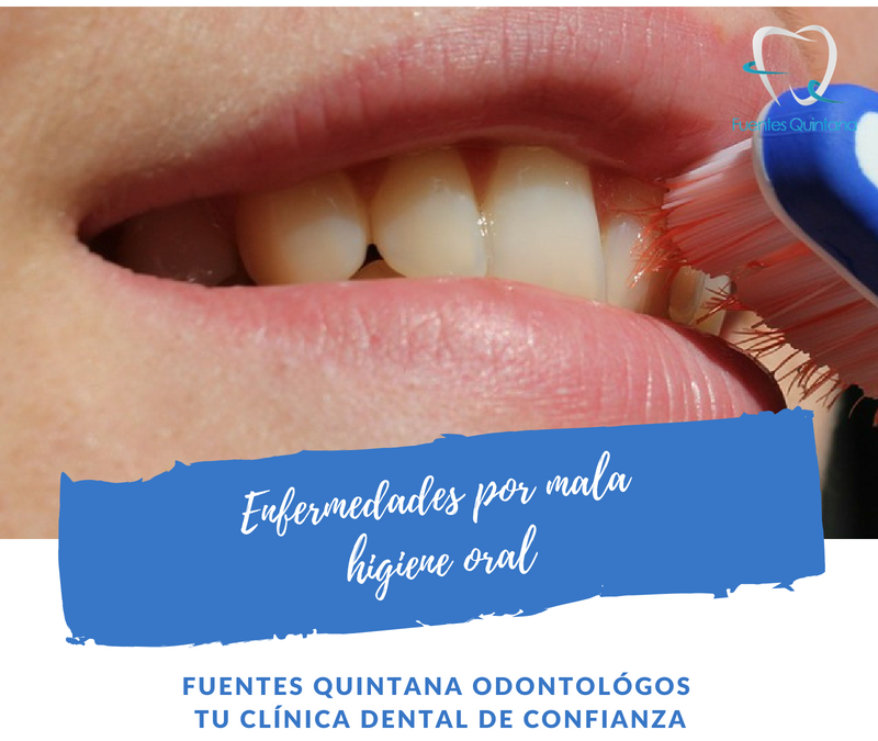 "enfermedades por mala higiene oral - clínica Fuentes Quintana Odontólogos"
