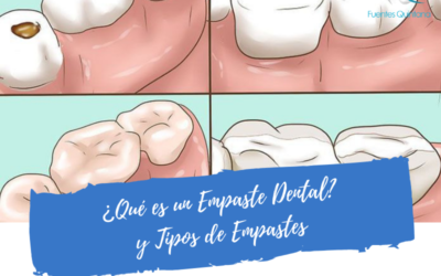 ¿Qué es un Empaste Dental? y Tipos de Empastes