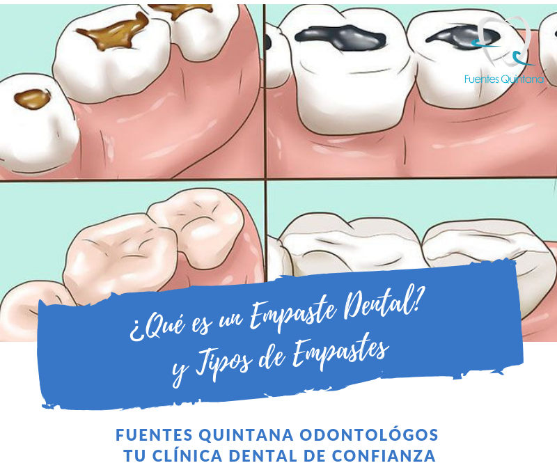 ¿Qué es un Empaste Dental? y Tipos de Empastes
