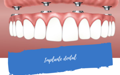 Implante Dental