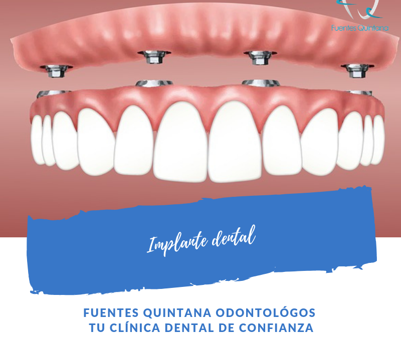 Implante Dental