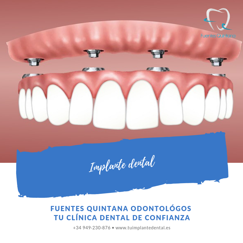 "implante dental Clínica Fuentes Quintana odontólogos Guadalajara"
