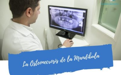 La Osteonecrosis de la Mandíbula