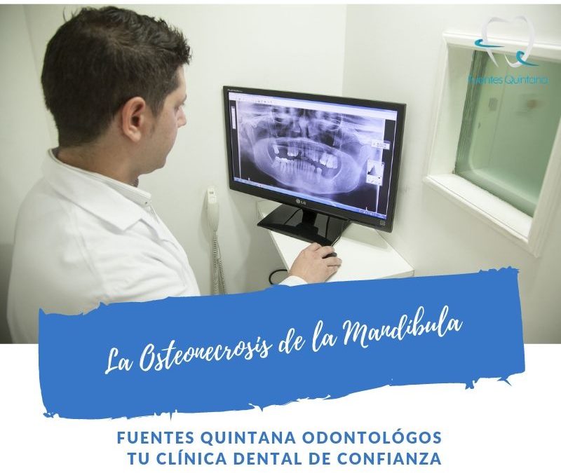 La Osteonecrosis de la Mandíbula