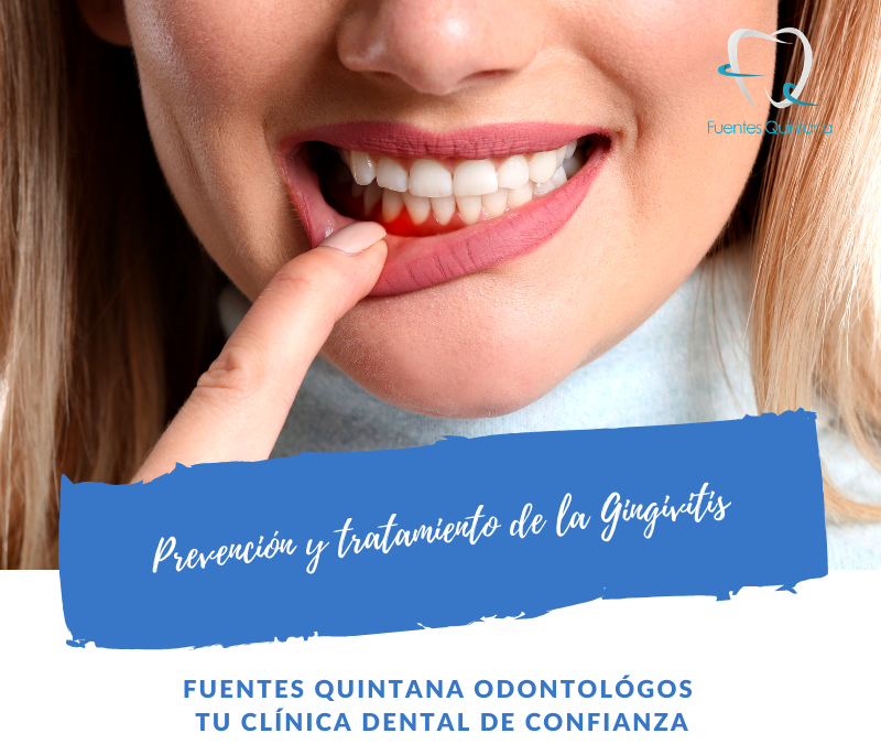 Prevención y tratamiento de la Gingivitis - Fuientes Quintana odontólogos Guadalajara