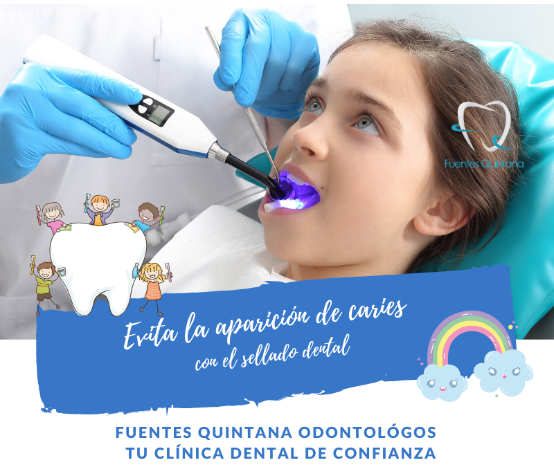 Evita la aparición de caries con el sellado dental