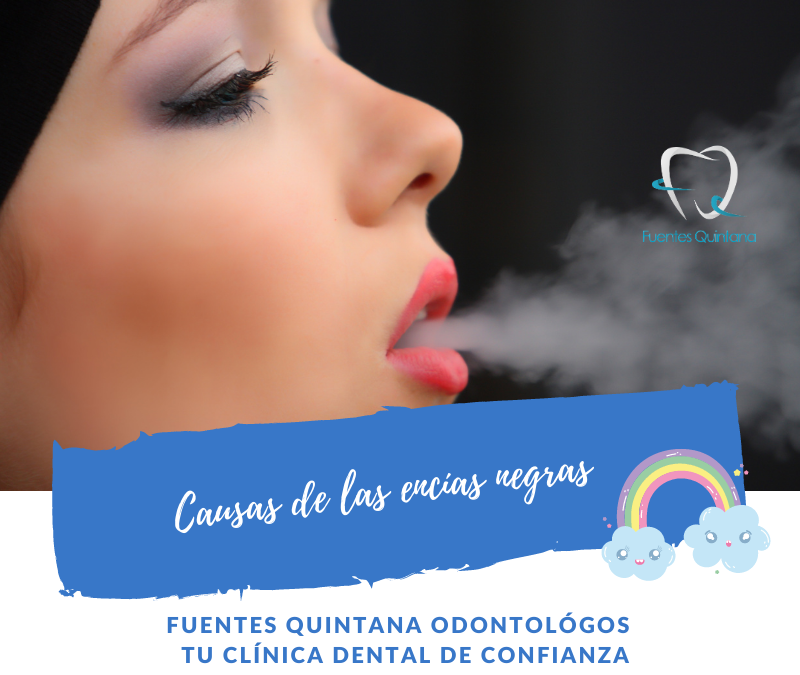 Causas de las encías negras - Tu implante dental - Clinica Fuentes Quintana odontologos Guadalajara