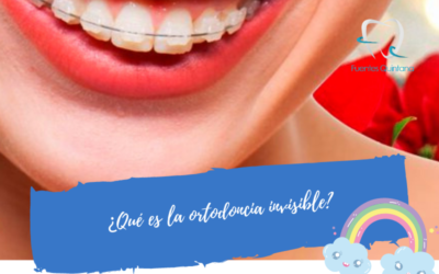 ¿Qué es la ortodoncia invisible – Invisalign?