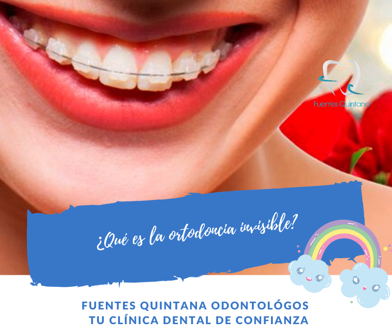 ¿Qué es la ortodoncia invisible – Invisalign?