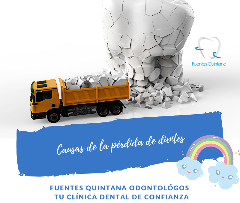 Causa de la pérdida de dientes - Clçinica dental Fuentes Quintana Odontólogos Guadalajara