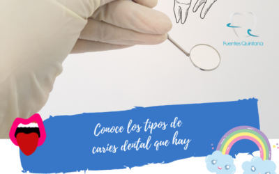 Conoce los tipos de caries dental que hay