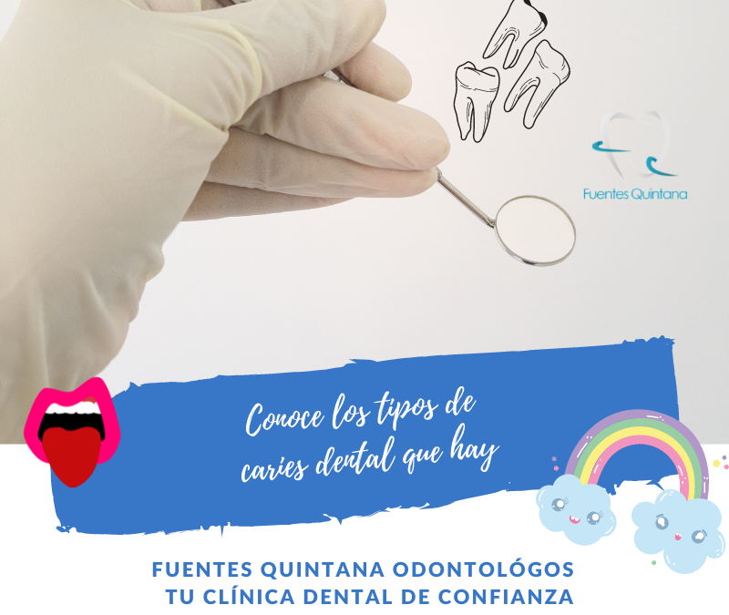 Conoce los tipos de caries dental que hay - Tu implante dental - Clinica dental Fuentes Quintana