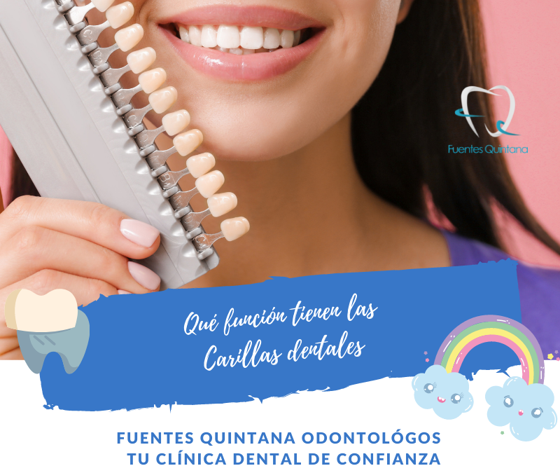 carillas dentales - clínica dental Fuentes Quintana Guadalajara