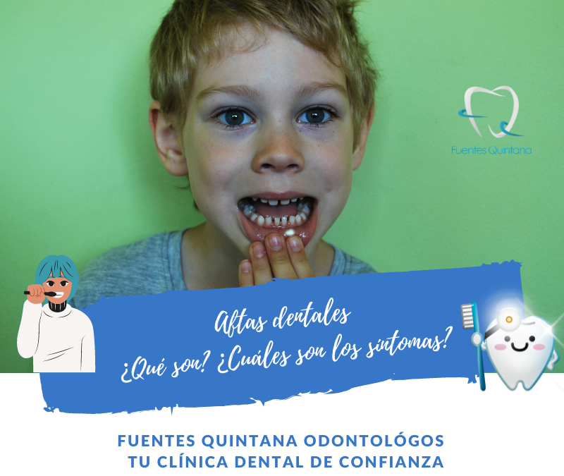 Aftas bucales