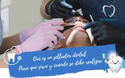 Qué es un sellador dental