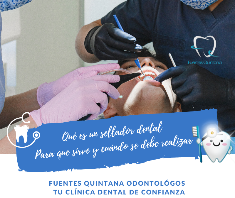 Qué es un sellador dental