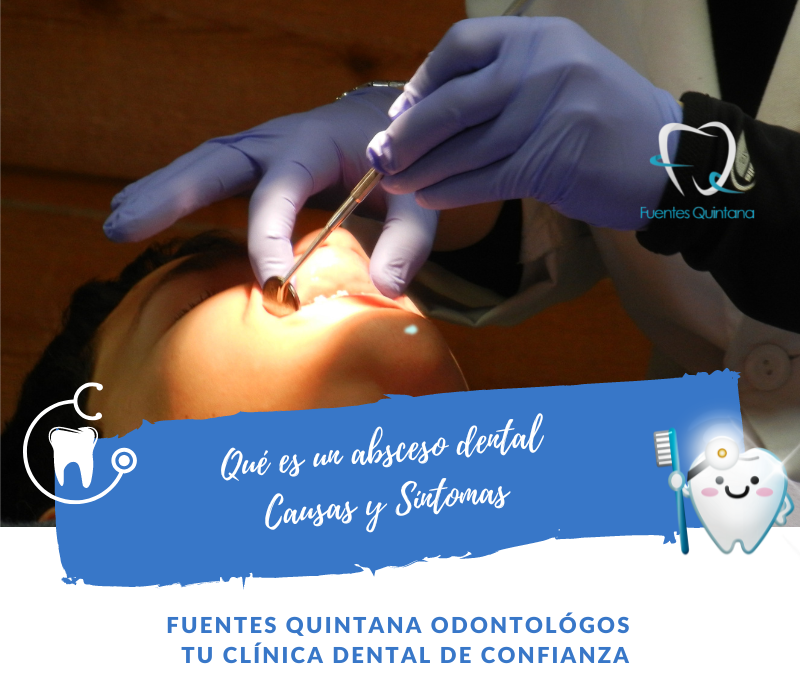 Qué es un absceso dental