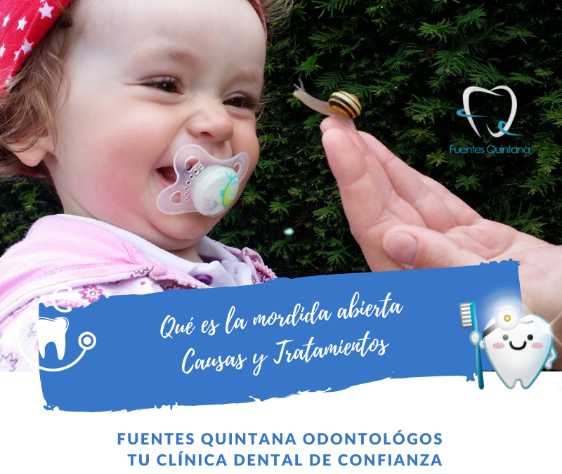 Qué es la mordida abierta o maloclusión dental