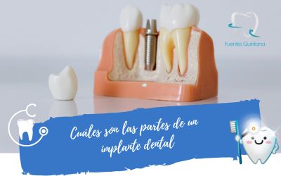 Cuáles son las partes de un implante dental