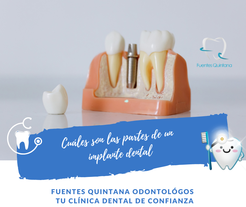 Cuáles son las partes de un implante dental