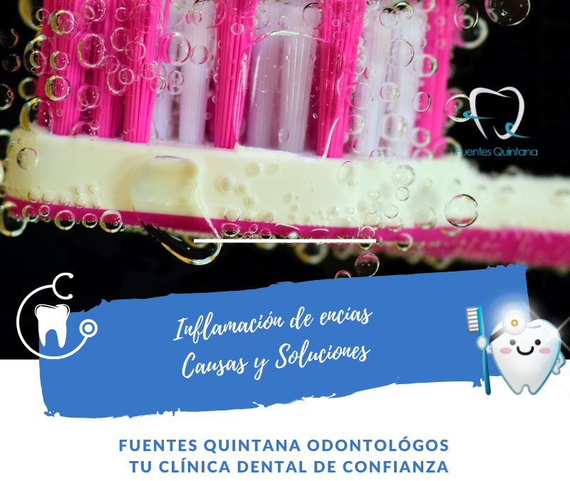 Inflamación de encías