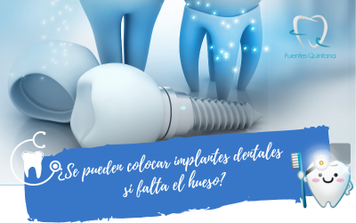 ¿Se pueden colocar implantes dentales si falta el hueso?