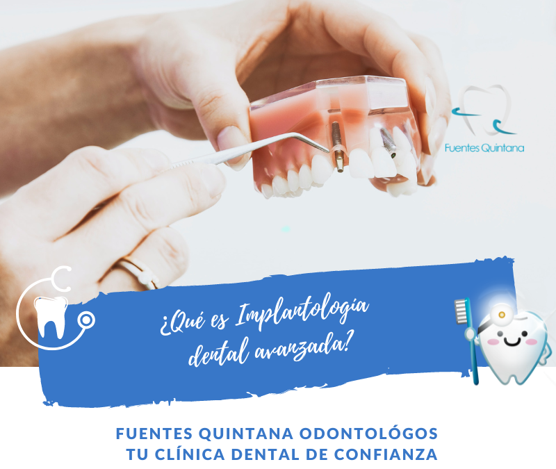 Implantología dental avanzada - Clinica dental Fuentes Quintana Guadalajara