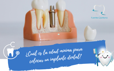 ¿Cuál es la edad mínima para un implante dental?