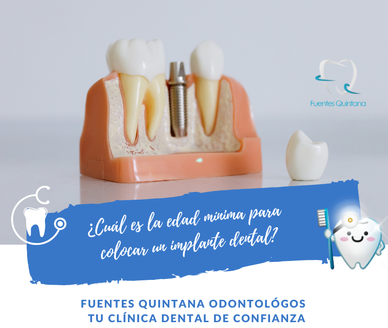 edad mínima para un implante dental - Clinica dental Fuentes Quintana Guadalajara