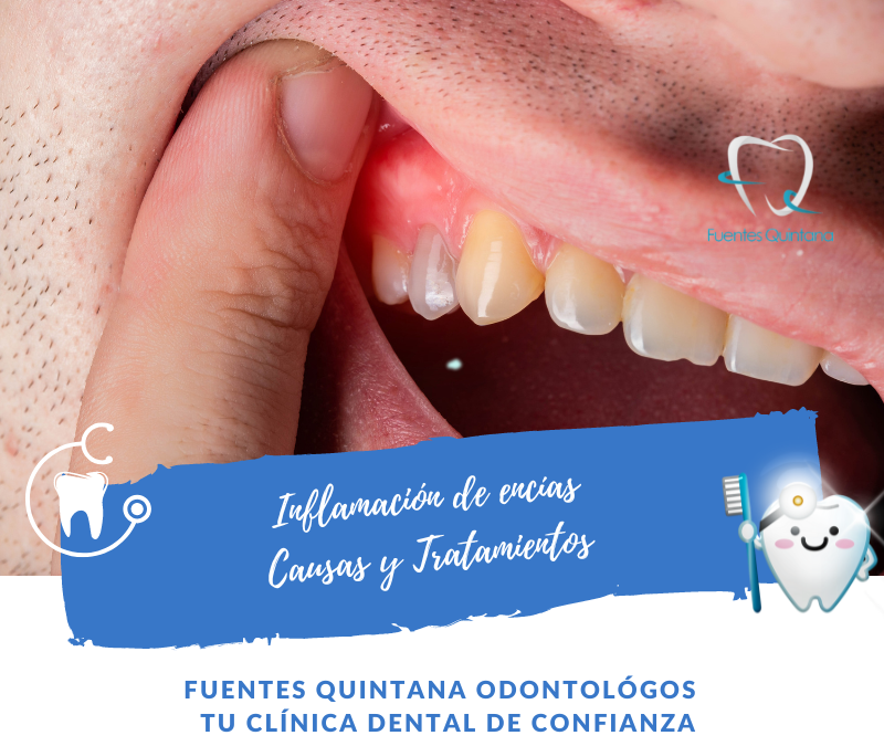 Por qué se inflaman las encías - clínica dental Guadalajara Fuentes Quintana