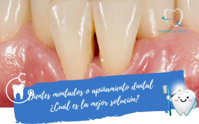 Dientes montados o apiñamiento ¿Cómo solucionarlo?