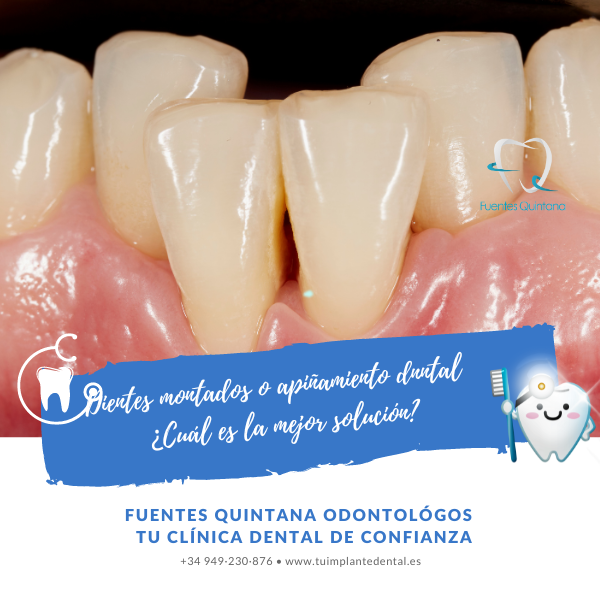 dientes montados - Clinica dental Fuentes Quintana Guadalajara (1)