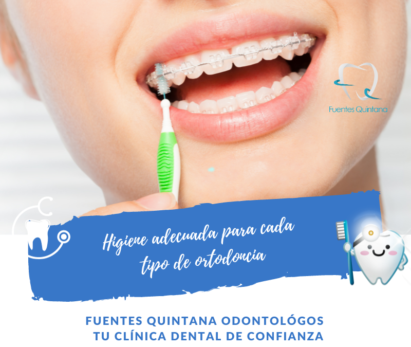 Higiene adecuada para cada tipo de ortodoncia