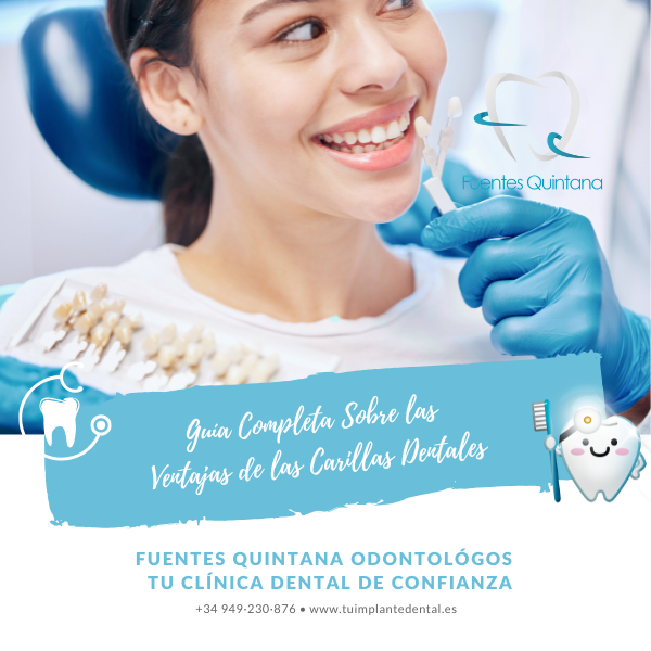 Guía Completa Sobre las Ventajas de las Carillas Dentales