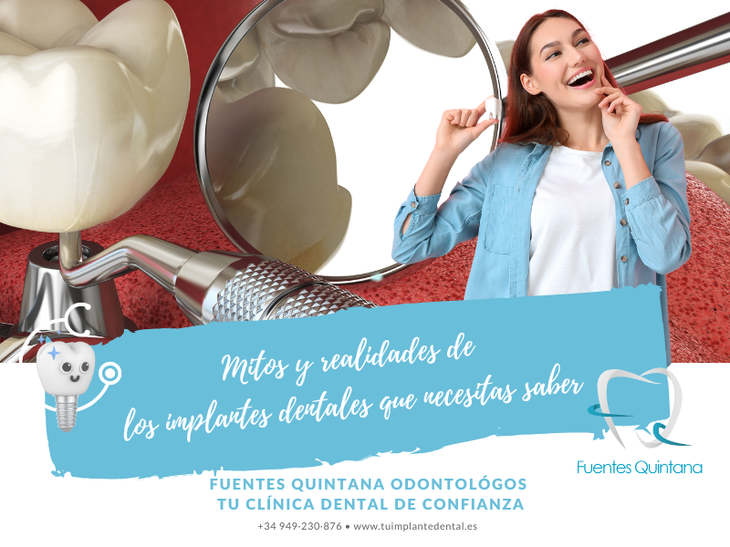 Mitos y realidades de los implantes dentales que necesitas saber 