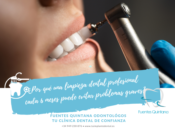¿Por qué una limpieza dental profesional cada 6 meses puede evitar problemas graves? - vtu implante dental Guadalajara - Clínica dental Fuentes Quintana