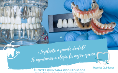 Implante o puente dental en Guadalajara