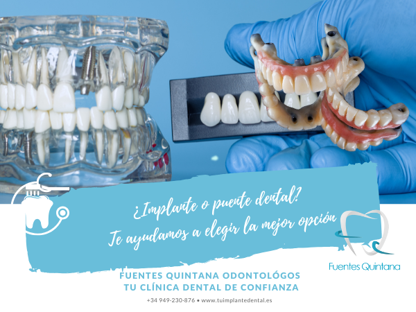 Implante o puente dental en Guadalajara